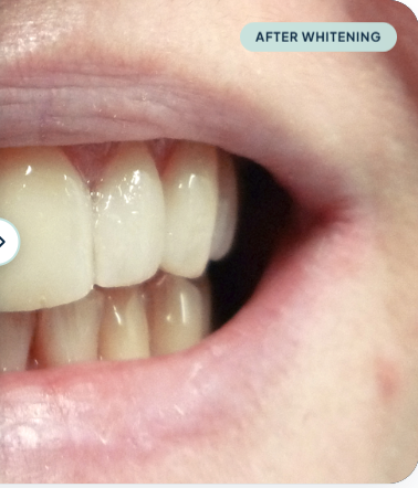 Teeth After Treatment