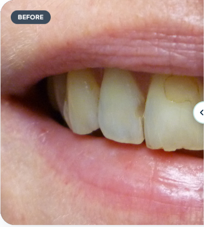Teeth Before Treatment